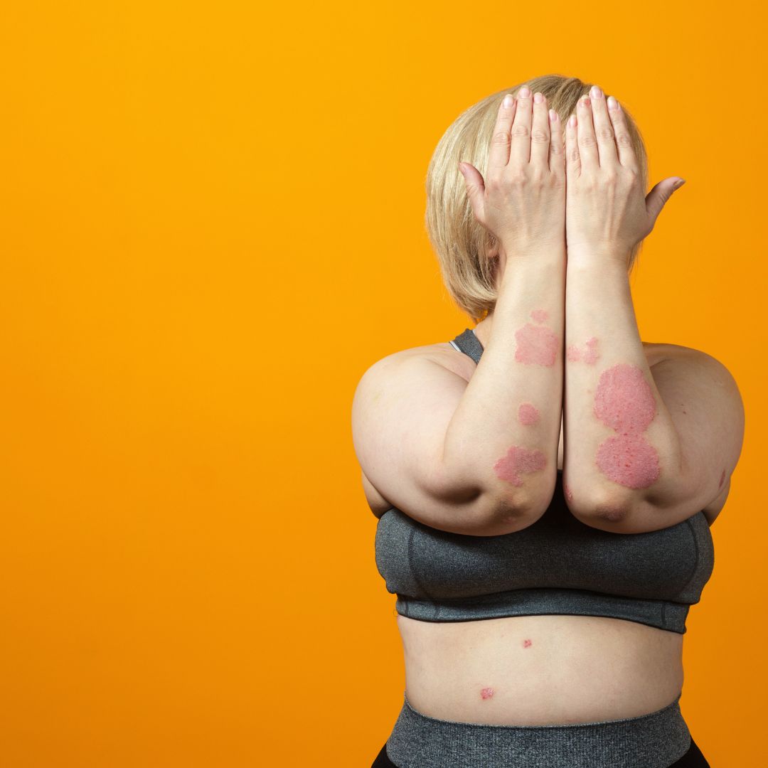The Eight Stages of Psoriasis