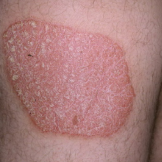 Everything you need to know about Plaque Psoriasis